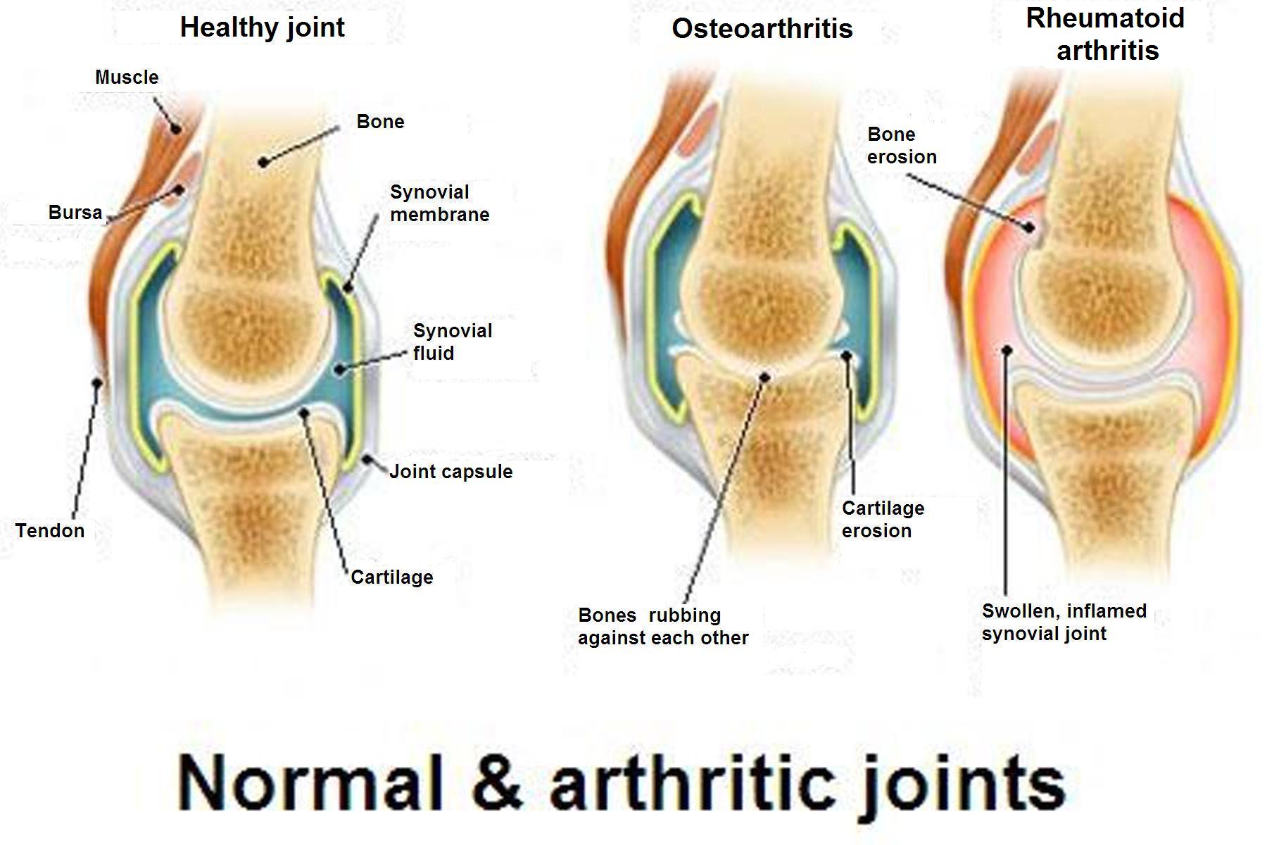 healthy joint, joint with osteoarthritis, joint with rhematoid arthritis
