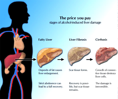 Homeopathic doctors for fatty liver disorder. What is a fatty liver disorder. Homeopathy remedies with cure for fatty liver disorder without side effects.
