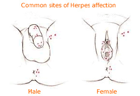 herpes sites