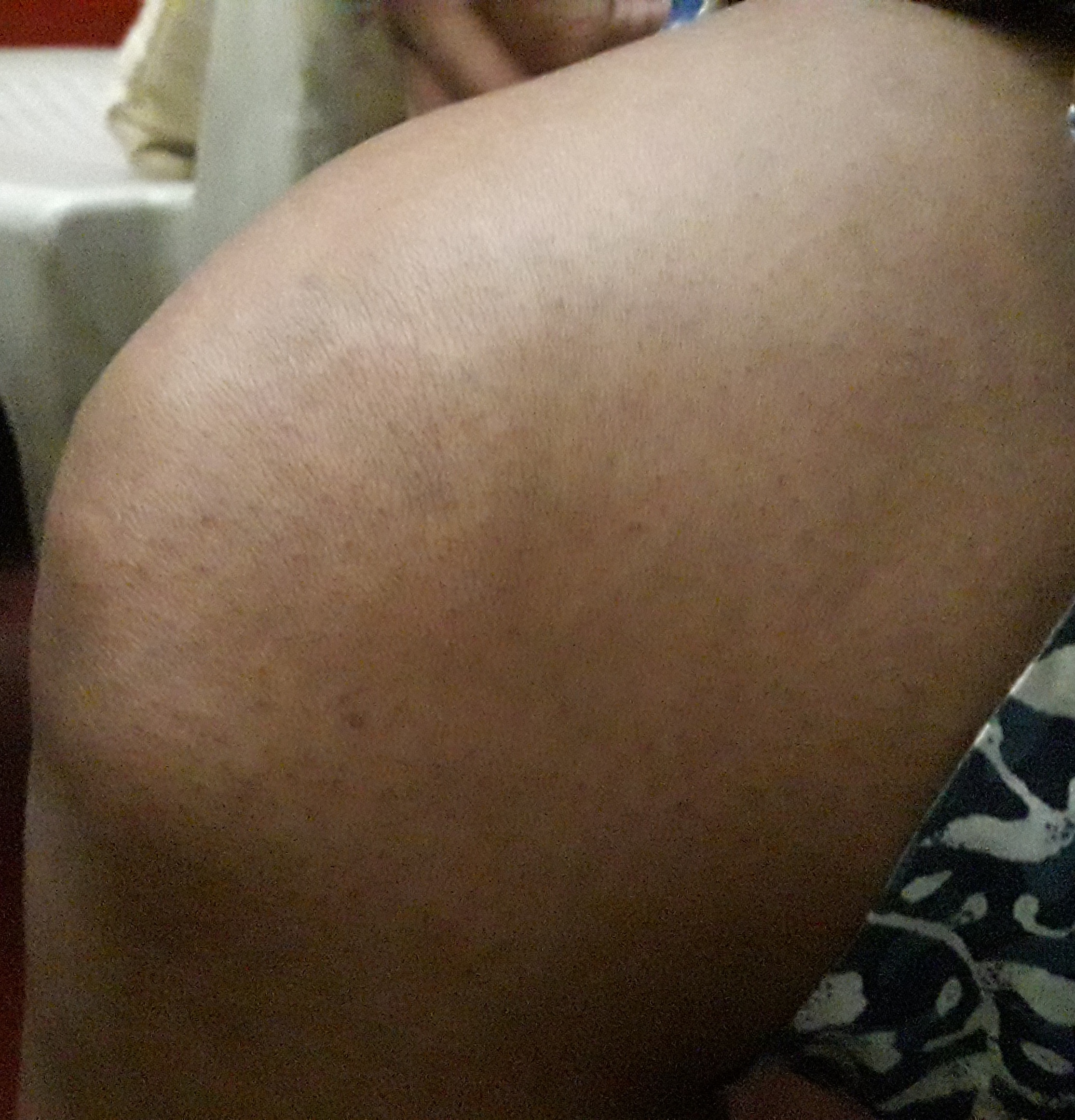 molluscum contagiosum after homeopathic treatment