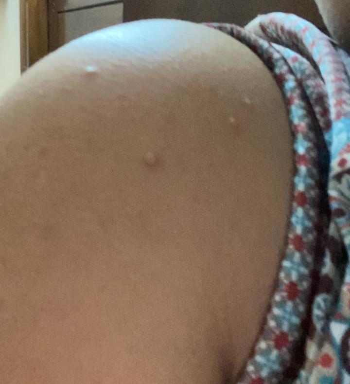 molluscum contagiosum before homeopathic treatment