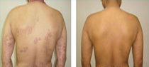 psoriasis best homeopathic doctor before and after homeopathic treatment